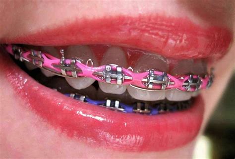 benefits of power chain braces.